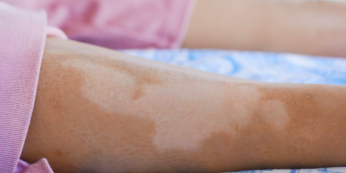 Científicos del IPN investigan vínculo de la obesidad como factor para tener vitíligo
